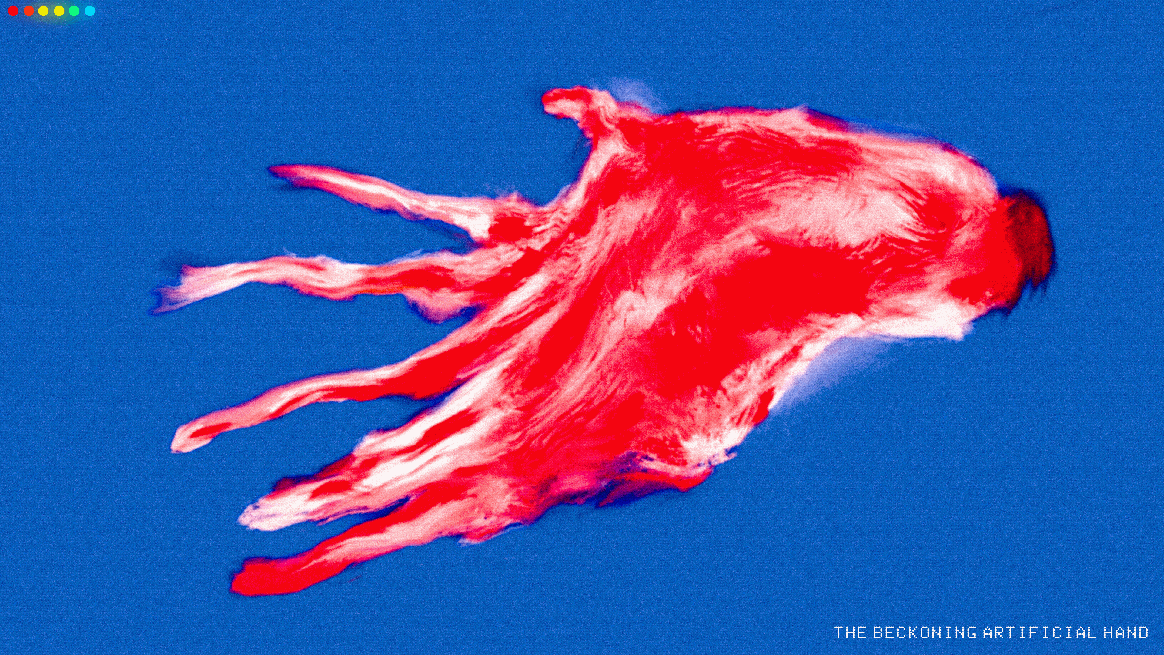 Dupuytren's Contracture of the Metacarcus